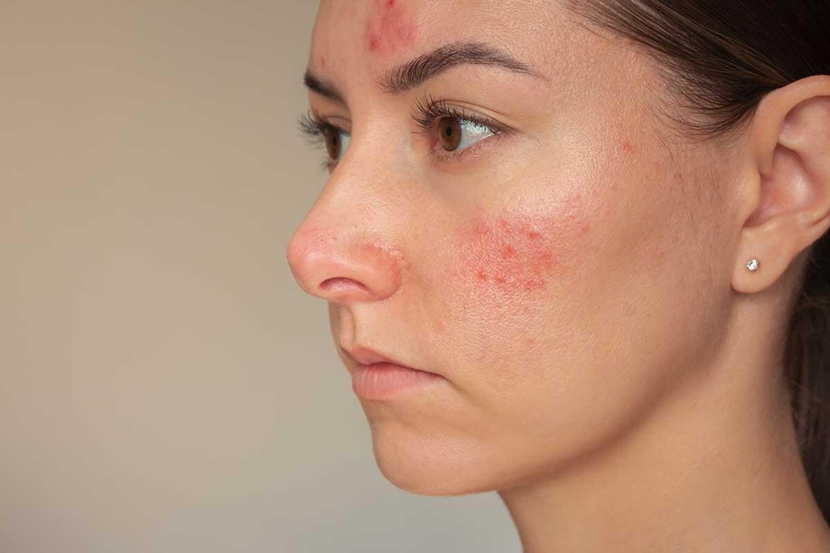 Rosacea: Cause, Sintomi e Trattamenti Efficaci