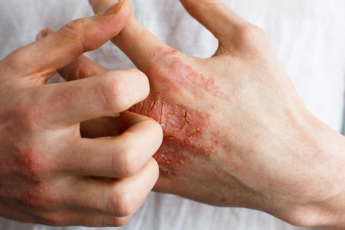 Allergie: Cause, Sintomi e Trattamenti