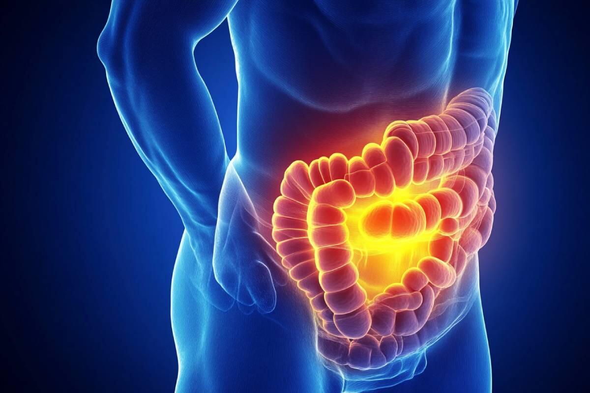 7 Sintomi del Cancro Intestinale da Non Ignorare Mai!