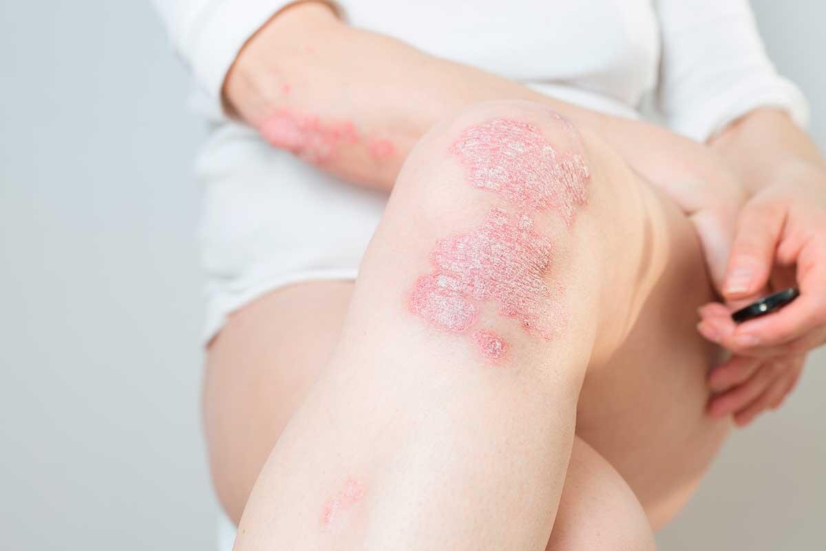 Entendendo la Psoriasi: Cause, Sintomi e Trattamenti Efficaci