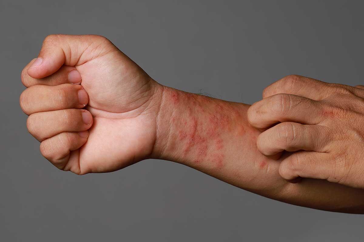 Eczema: Sintomi, Cause e Trattamenti Efficaci