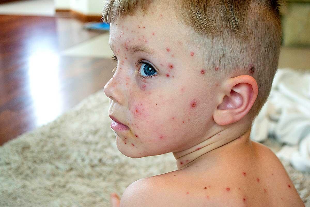 Catapora, Rosolia e Morbillo: Sintomi, Prevenzione e Trattamenti
