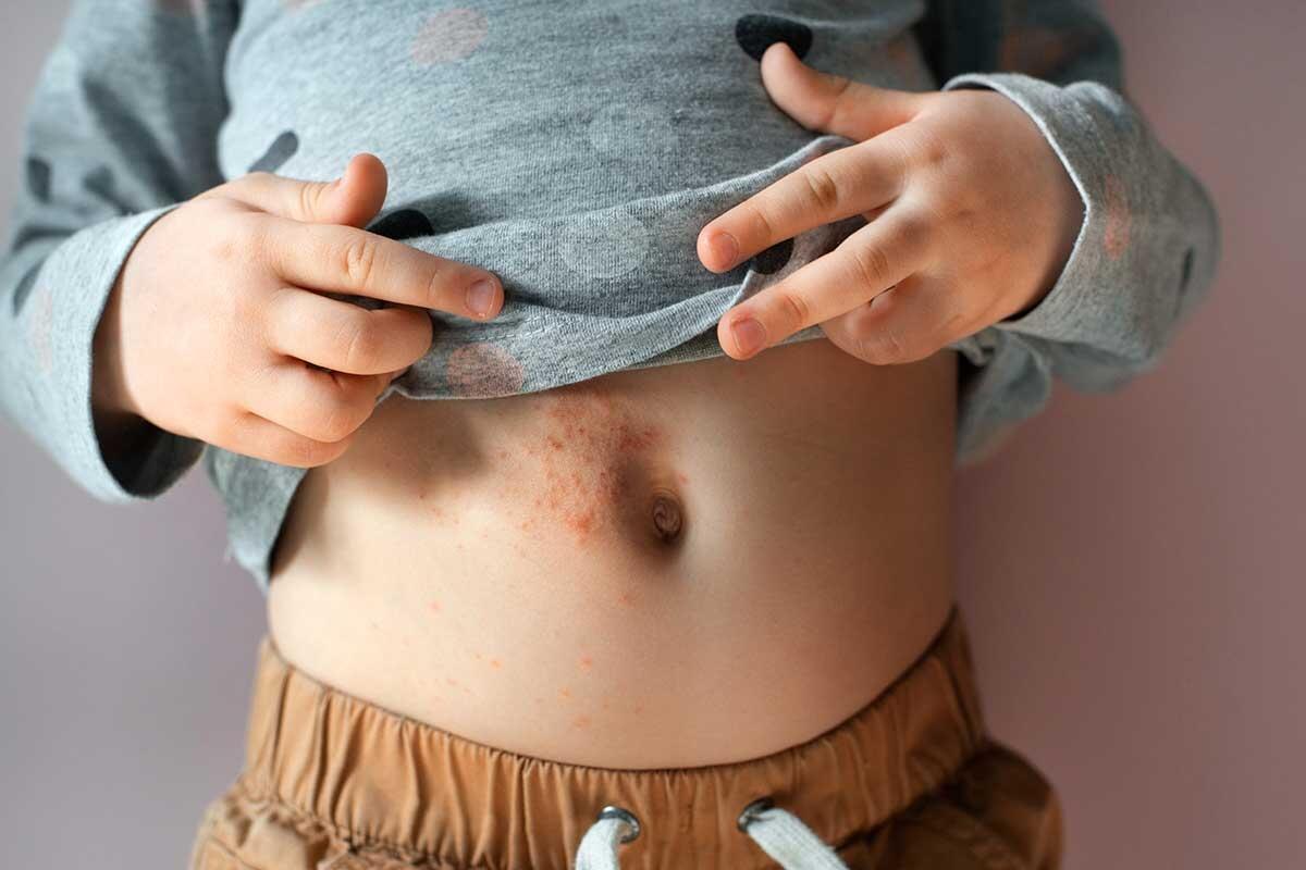 Sarna (Scabbia): Cause, Sintomi e Trattamenti Efficaci
