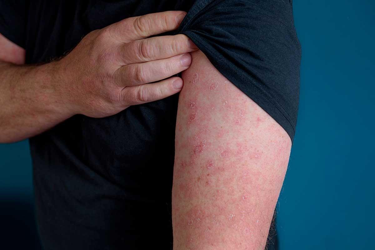Erisipela: Sintomi, Cause e Trattamenti Efficaci